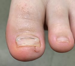 Wrastający paznokieć - leczenie klamrą